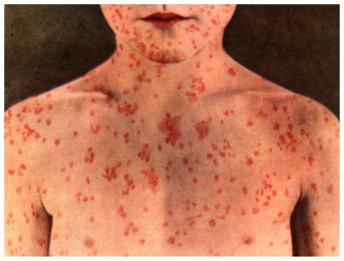 page-42-Does-my-child-have-measles1